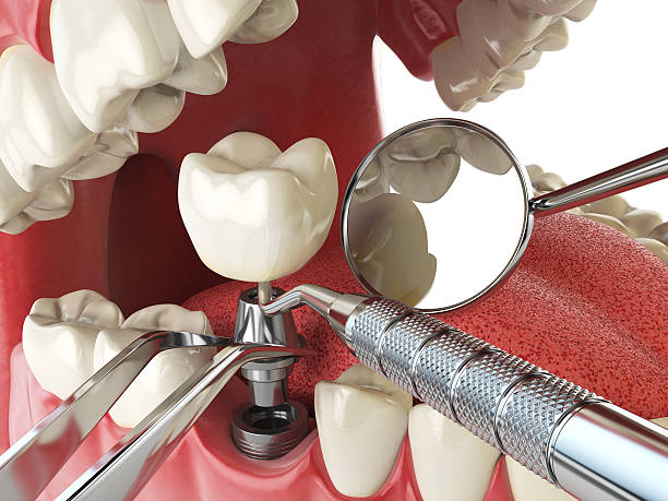 Best Emergency Dentist for Lost Fillings or Crowns in Vassar College, NY